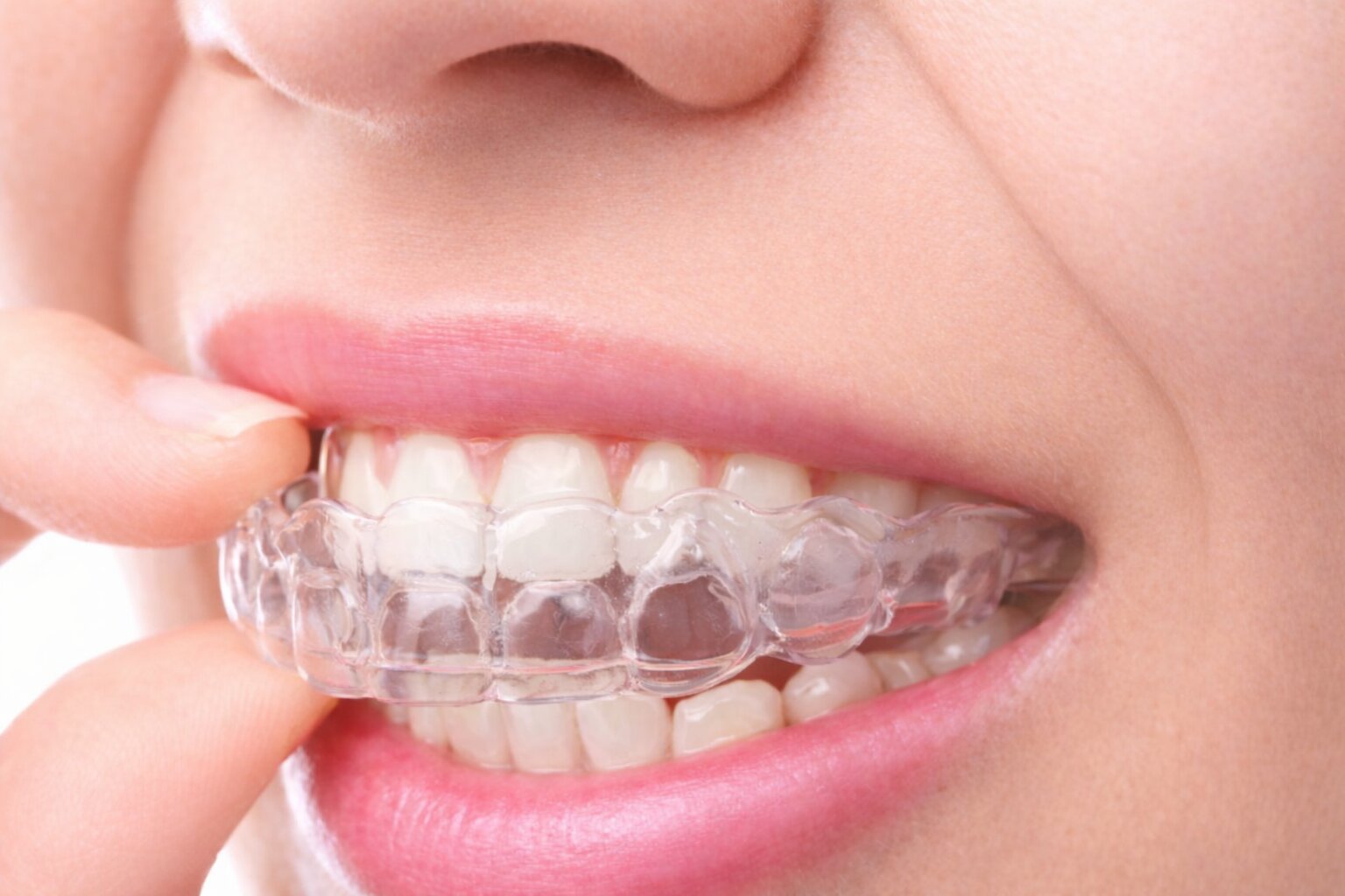 Invisalign clear aligner being placed on teeth at dental clinic near UBC Vancouver